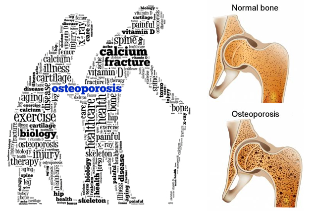 How to Prevent Osteoporosis?