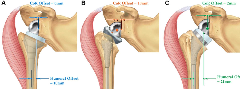 reverse total shoulder replacement